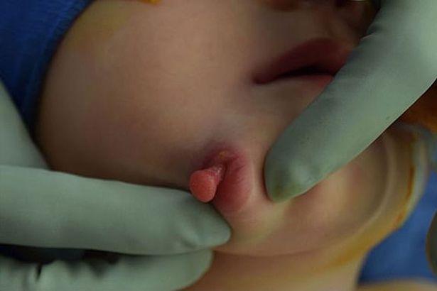 Bebelușa care i-a lăsat muți pe medici. Ce avea fetița pe obraz, la naștere: „Există doar 35 de cazuri, în istorie!” - FOTO