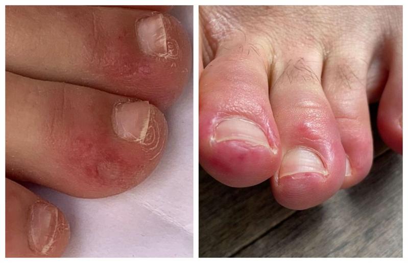 Cum arată „degetul COVID-19”. Ce se întâmplă cu picioarele unor pacienți cu noul coronavirus. Atenție, imagini greu de privit! FOTO