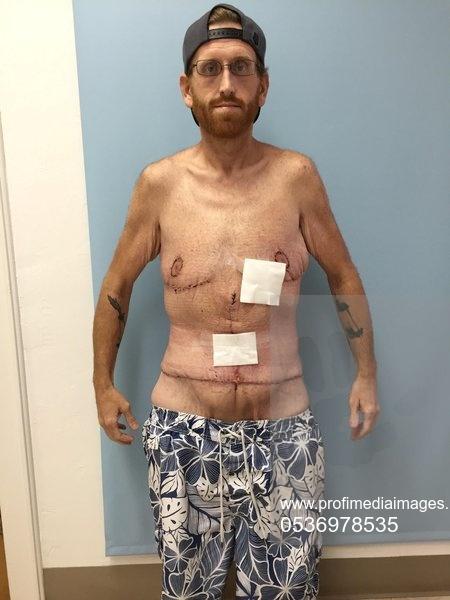 DIETA cu legume. Priviți-l! Avea 500 de kg și a slăbit peste 350 de kg mâncând! Nu a fost nici măcar o zi la sală pentru că nu a vrut. A slăbit urmând o dietă ușoară