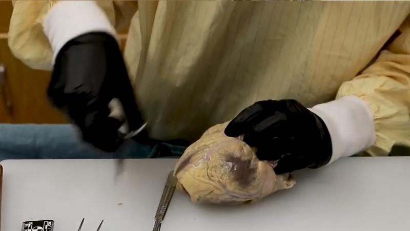 Cum arată inima unui om care a murit de COVID-19. Medic: „Are margini dilatate”. Atenție, imagini ce vă pot afecta emoțional! VIDEO