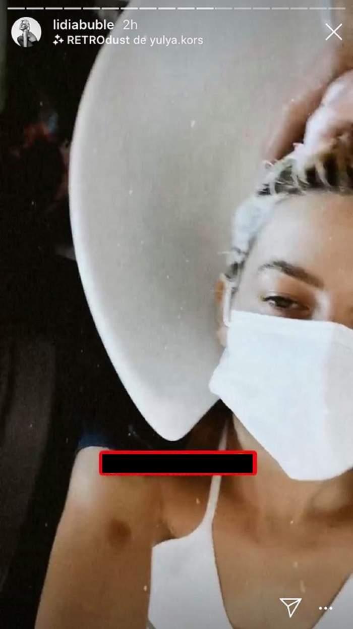 Lidia Buble, plină de vânătăi pe corp! Ce s-a întâmplat cu artista? Le-a explicat fanilor totul pe Internet