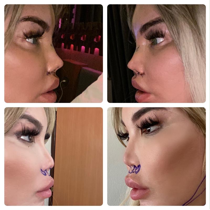 Dependent de operații estetice. Fostul “bărbat Ken” își remodelează nasul pentru a semănă și mai bine cu o păpușă Barbie