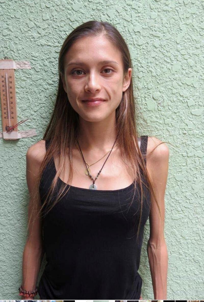 Femeia care a mâncat doar salată, roșii și mere timp de doi ani. Cum arată după ce a învins anorexia | FOTO