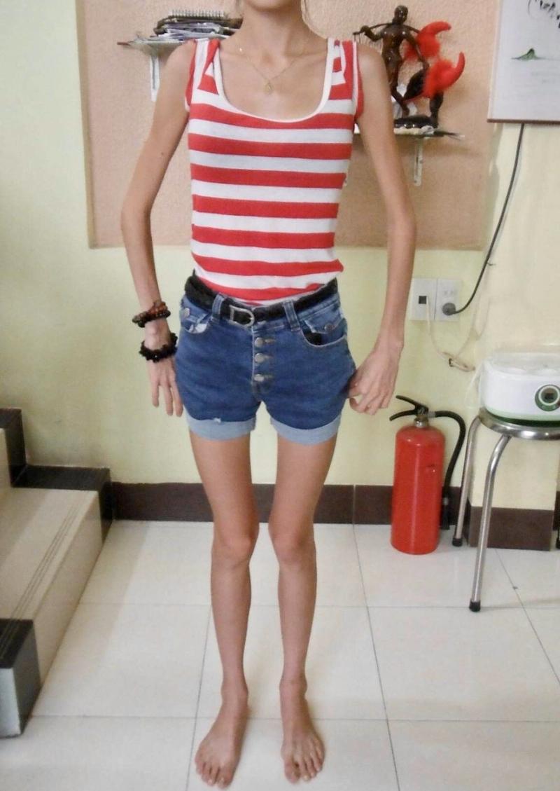 Femeia care a mâncat doar salată, roșii și mere timp de doi ani. Cum arată după ce a învins anorexia | FOTO