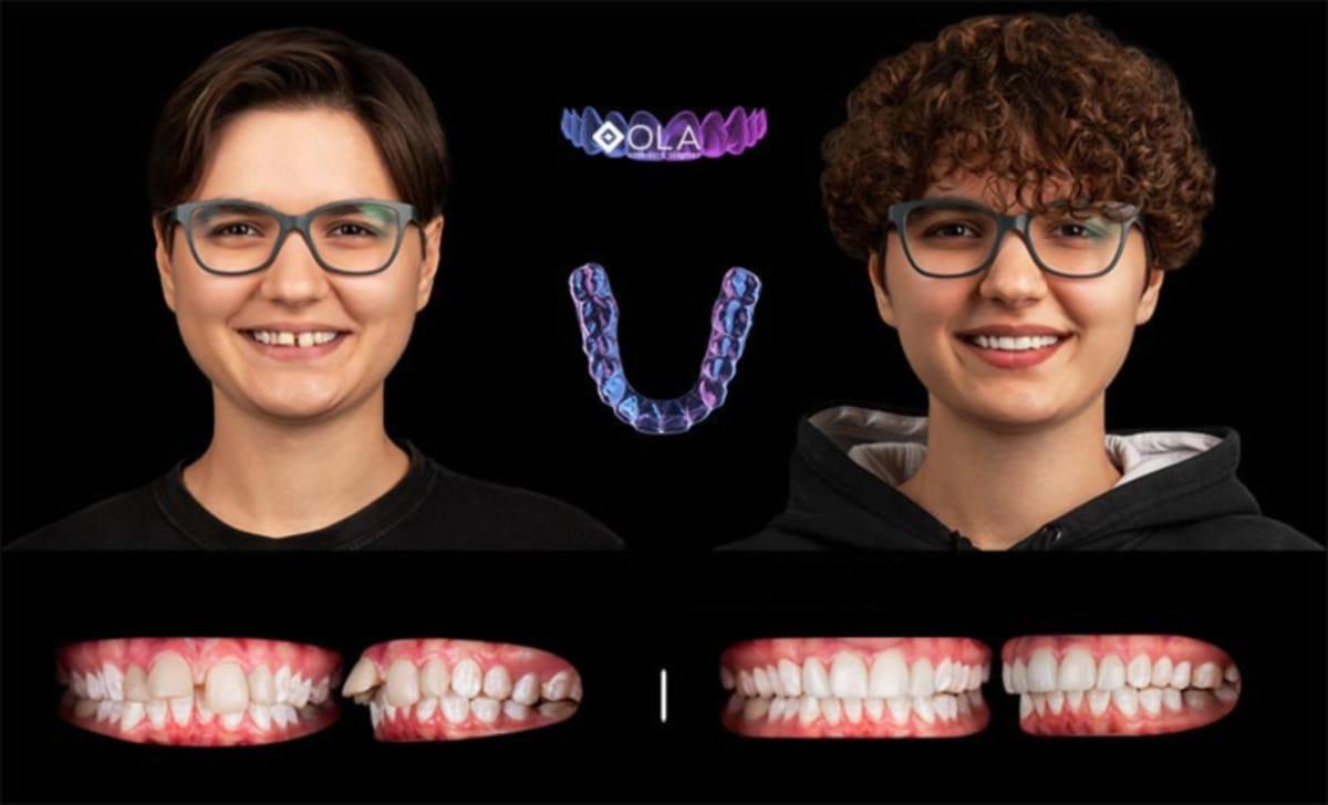 (P) OLA, aparatul dentar invizibil care îți schimbă zâmbetul. Află de la specialiștii Dentus•Dentino de ce este considerat o revoluție în stomatologie.