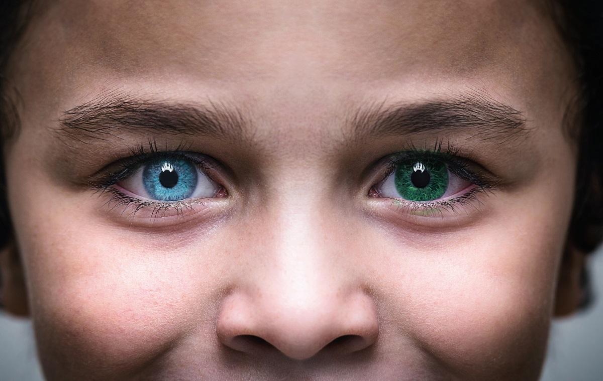 Как называется болезнь когда разный цвет глаз. Центральная гетерохромия глаз. Центральная гетерохромия зеленый Карий. Гетерохромия радужной оболочки. Центральная гетерохромия хамелеон.