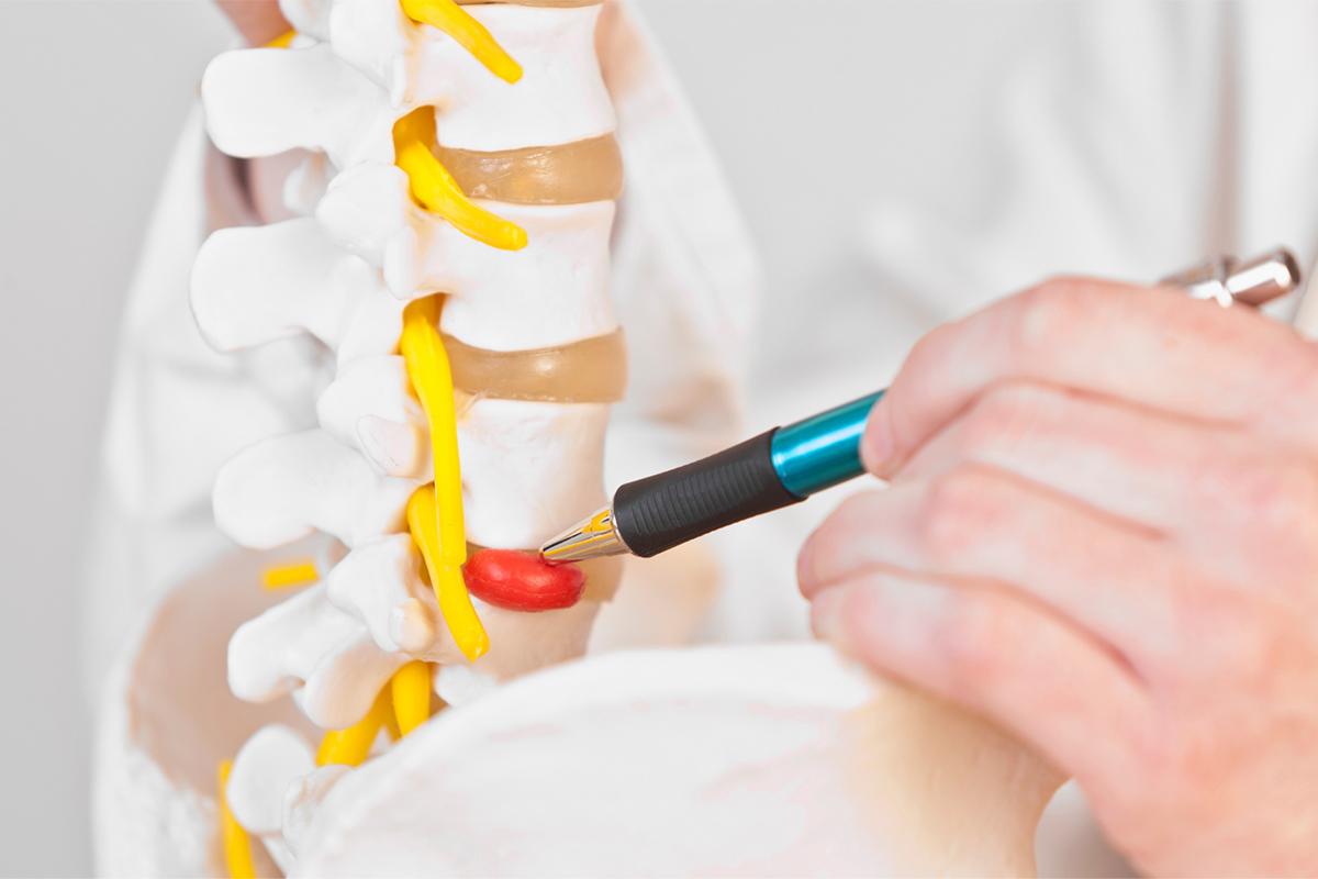 hernie de disc , reprezentare