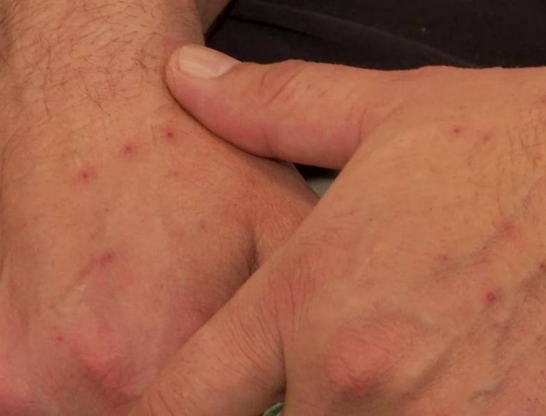 Românul din Marea Britanie, suspectat de variola maimuței în Grecia, are, de fapt, varicelă